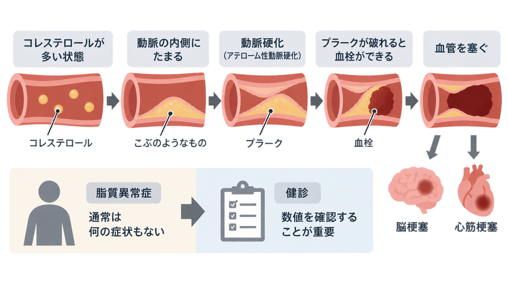血管内にコレステロールがたまってプラークができ、破れて血栓が血管を塞ぎ、脳梗塞や心筋梗塞につながる流れの図。下段には、脂質異常症は通常症状がなく健診で数値確認が重要と示されている。